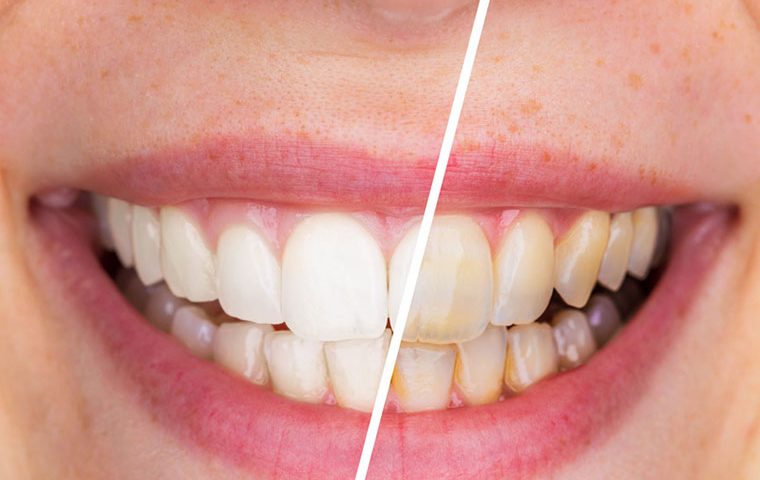 Why Scaling And Root Planning Are Necessary For Gum And Teeth