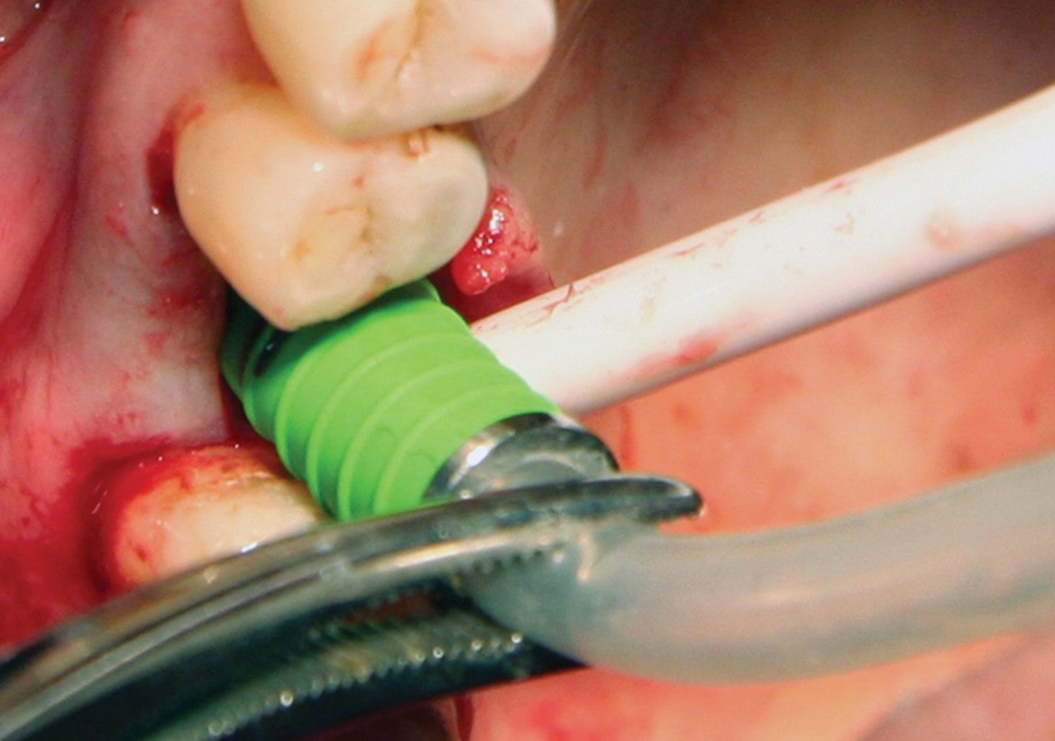 Sinus lift surgery; before, during the procedure, aftercare