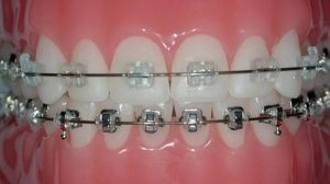 Metal Vs Ceramic Braces: Which Dental Brace Is Better ...