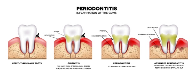 can my dog die from periodontal disease