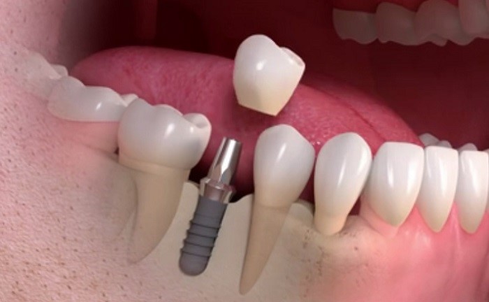 Can another dental implant be placed after the failed one is removed