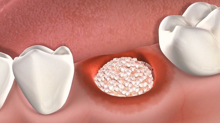 Can save implant with bone grafting