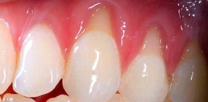 What causes receding gums