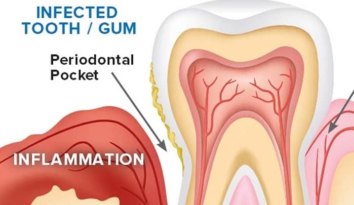 Who is at risk of getting gum infection