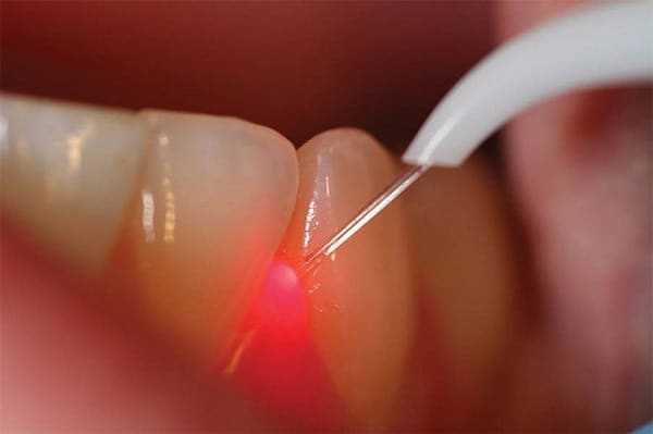 How laser technology can treat periodontal disease