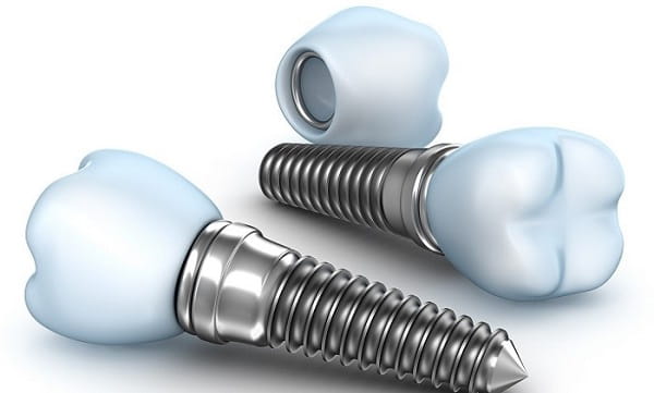 Cost of dental implants