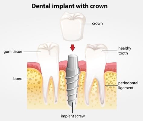 Crown