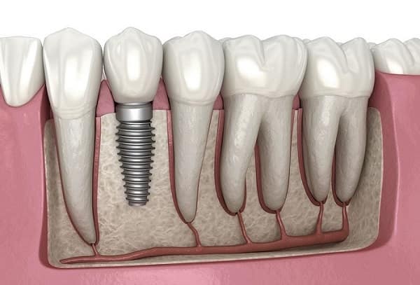 What to Expect During Your Dental Implant Procedure