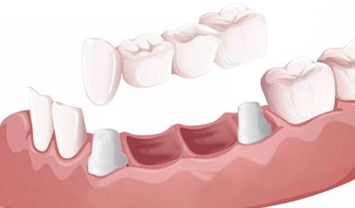 How is a ceramic bridge fitted