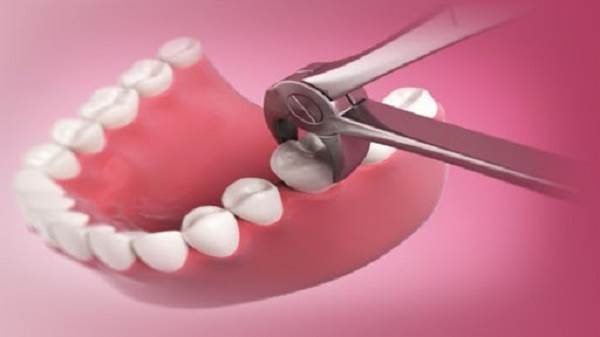 Why a Tooth Extraction