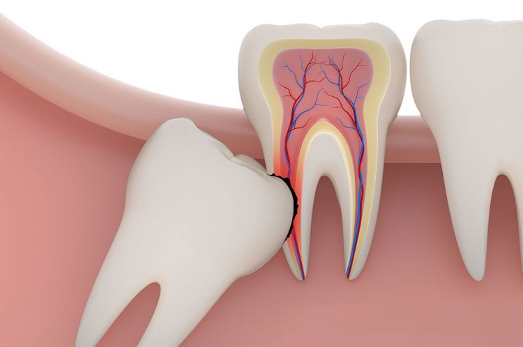upper wisdom tooth extraction