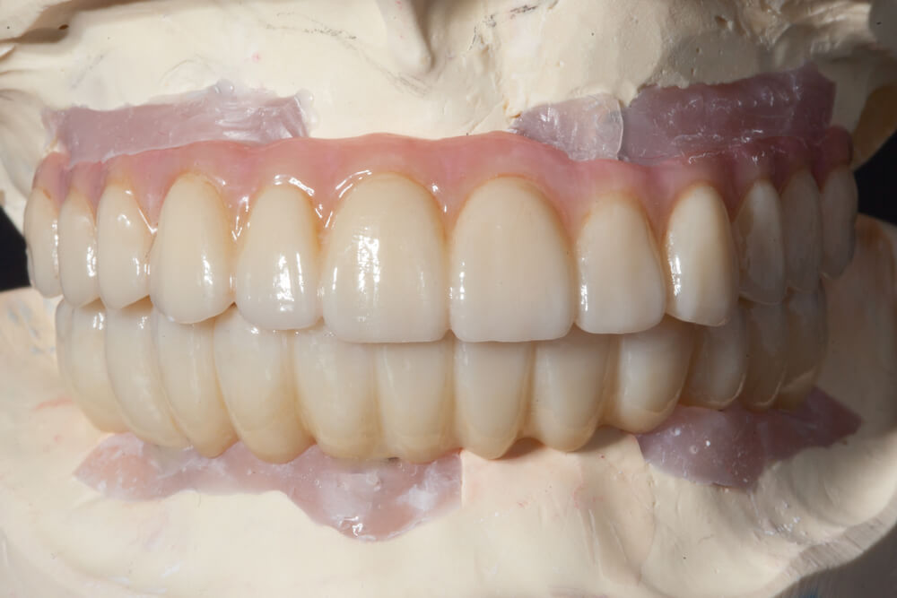 Zirconia for Double Arch Dental Implants